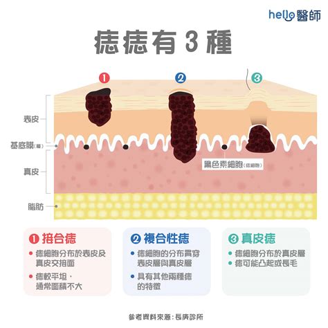 痣 形成原因|痣（黑素细胞痣）